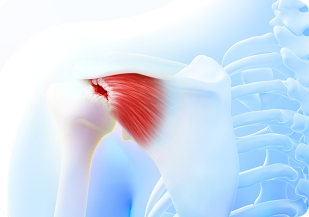 성모에스케이마취통증의학과의원 목디스크 탈출증 이미지